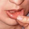 afte - mouth-ulcers